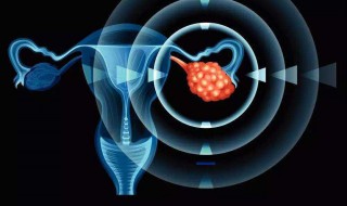 卵巢癌常见信号是什么 5个信号是卵巢癌“报到”