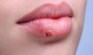 嘴唇上长水泡是什么原因 怀孕了嘴唇上长水泡是什么原因