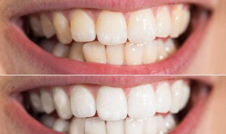 牙黄怎么变白简单方法小苏打 牙黄怎么变白简单方法