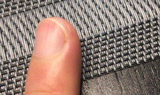 指甲有竖线是什么 指甲有竖线是什么病