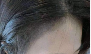 经常扎头发发际线会变高吗 碧莲盛植发官方网