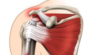 肌肉拉伤怎么快速恢复 肌肉拉伤怎么快速恢复胳膊疼