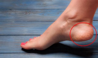 脚后跟皮肤粗糙用什么药可以治愈 脚后跟皮肤粗糙怎么办