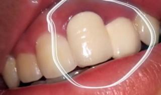 补牙玻璃离子有毒吗 儿童补牙用玻璃离子有毒害身体吗