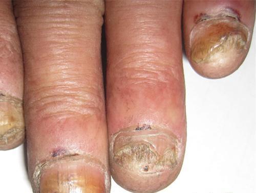 灰指甲的初期症状 灰指甲的初期症状怎么治疗