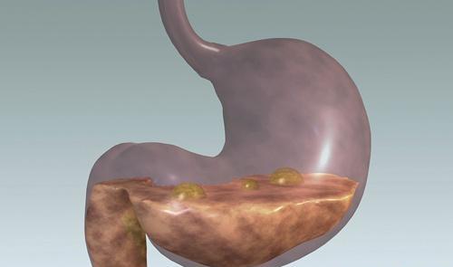 胃炎是怎么引起的 请问萎缩性胃炎是怎么引起的