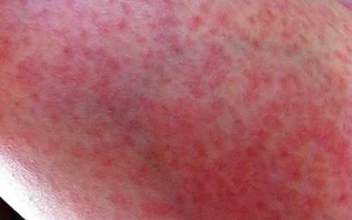 如何治疗皮肤过敏 如何治疗皮肤过敏瘙痒