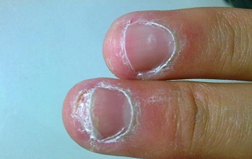 治疗灰指甲的最佳方法 治疗灰指甲的最佳方法效果怎么样