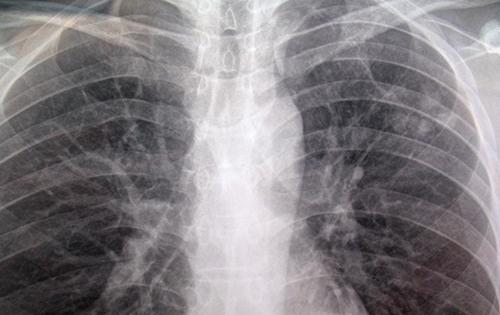 肺结核胸片多少钱拍一次 肺结核胸片