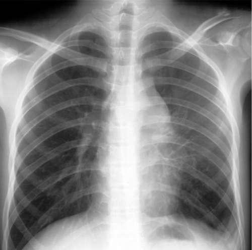 肺纹理增多 肺纹理增多什么意思严重吗