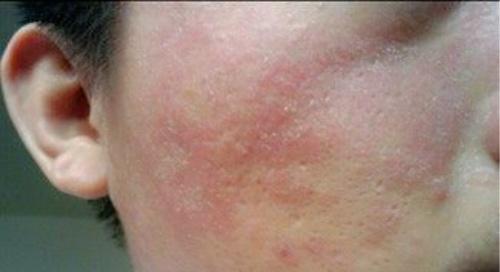 脂溢性皮炎传染吗 头皮脂溢性皮炎传染吗