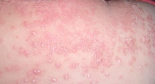 干燥型湿疹的偏方 干燥型湿疹的偏方治疗