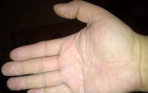 手掌脱皮是什么原因 手掌脱皮是缺少什么维生素