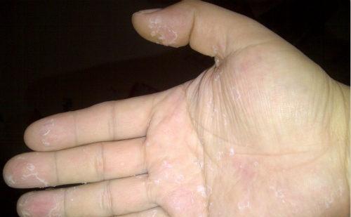 手指脱皮是什么原因缺什么维生素 手指脱皮是什么原因
