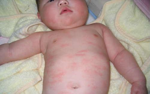 寒冷性荨麻疹的治疗方法 寒冷性荨麻疹怎么根治