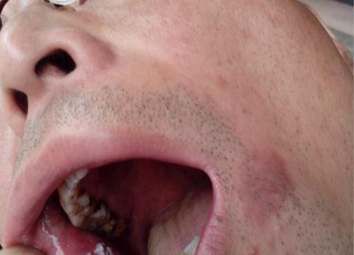 口腔白斑病的偏方有哪些 口腔白斑病的偏方