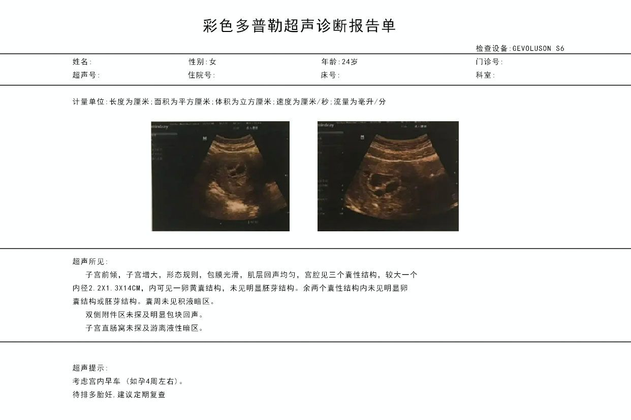 怀孕4周的彩超图片 怀孕4周的B超图片