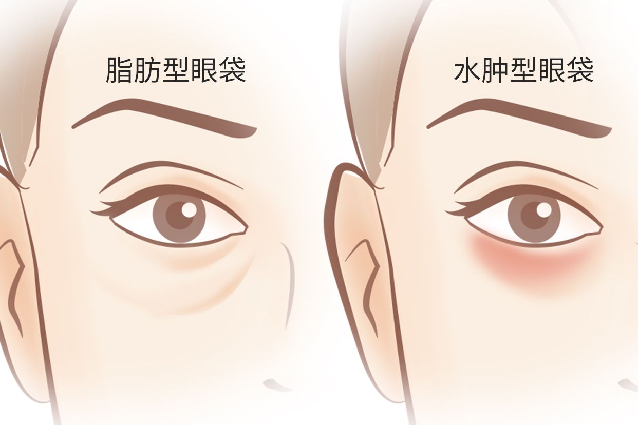 脂肪型眼袋和水肿型眼袋区别图 脂肪型眼袋和水肿型眼袋的区别