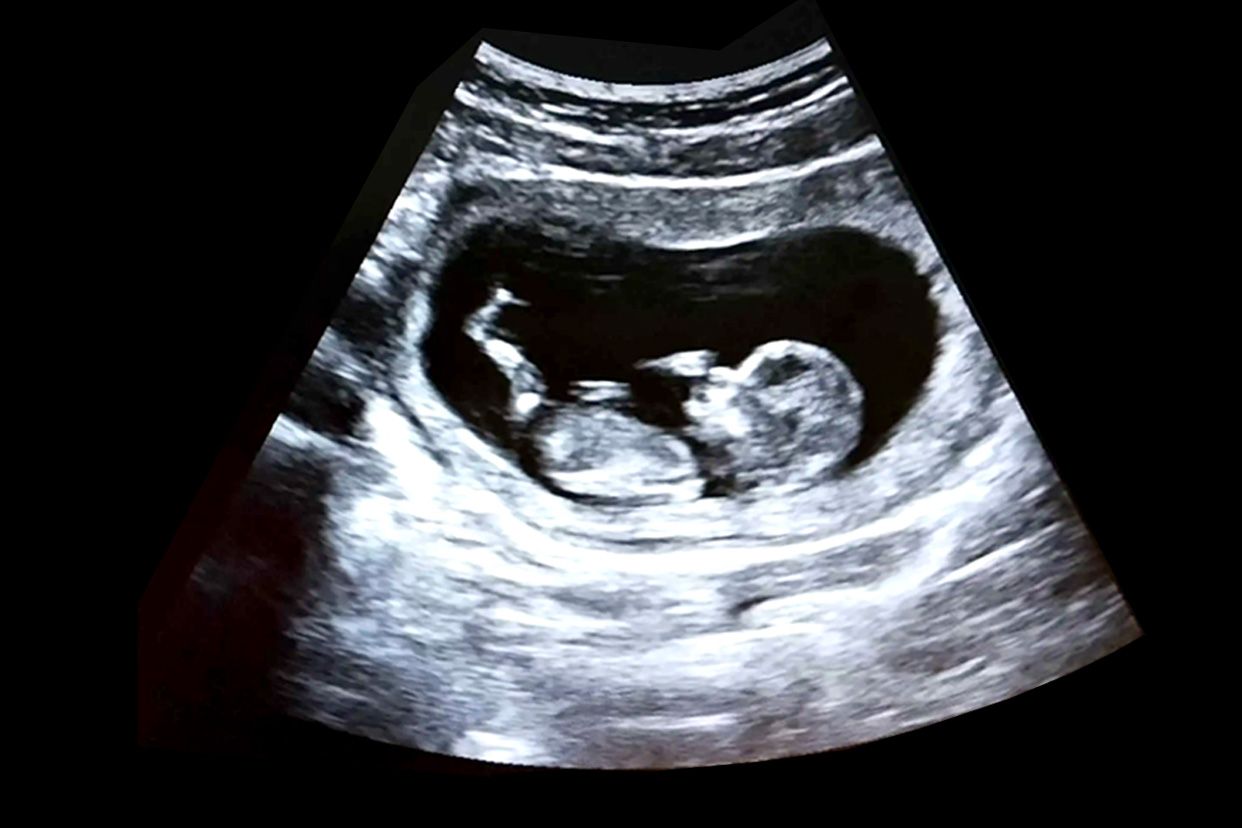 做nt能看清楚胎儿的脸吗 nt的胎儿图片可以看出脸型吗
