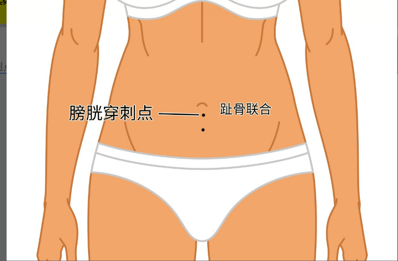 膀胱穿刺术位置 膀胱穿刺点的位置图片