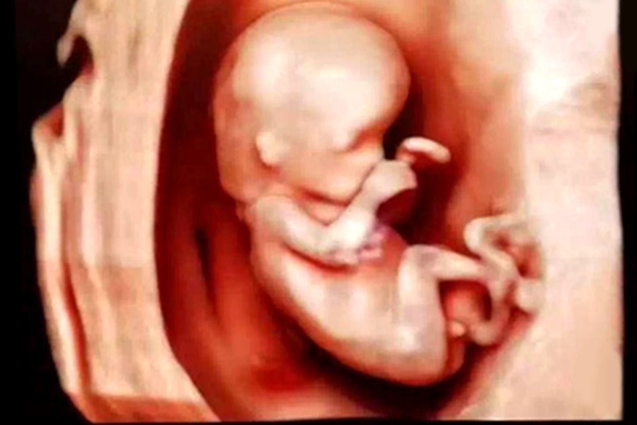 孕12周三维彩超图片 怀孕12周四维彩超图片