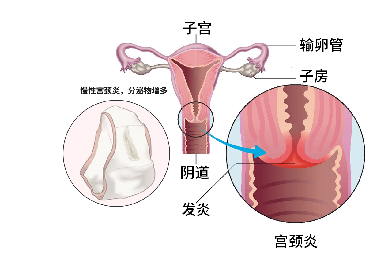慢性宫颈炎内裤的图片 宫颈炎早期症状内裤图片
