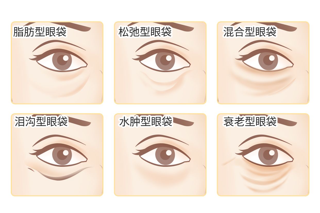 六种眼袋类型图片 六种眼袋类型图片