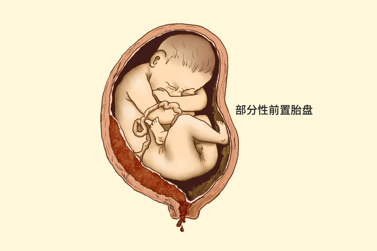 胎盘前置图解 部分性前置胎盘图片