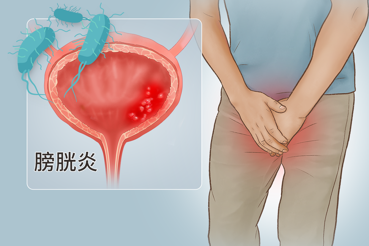 男性膀胱炎图片 男性膀胱炎的症状图片