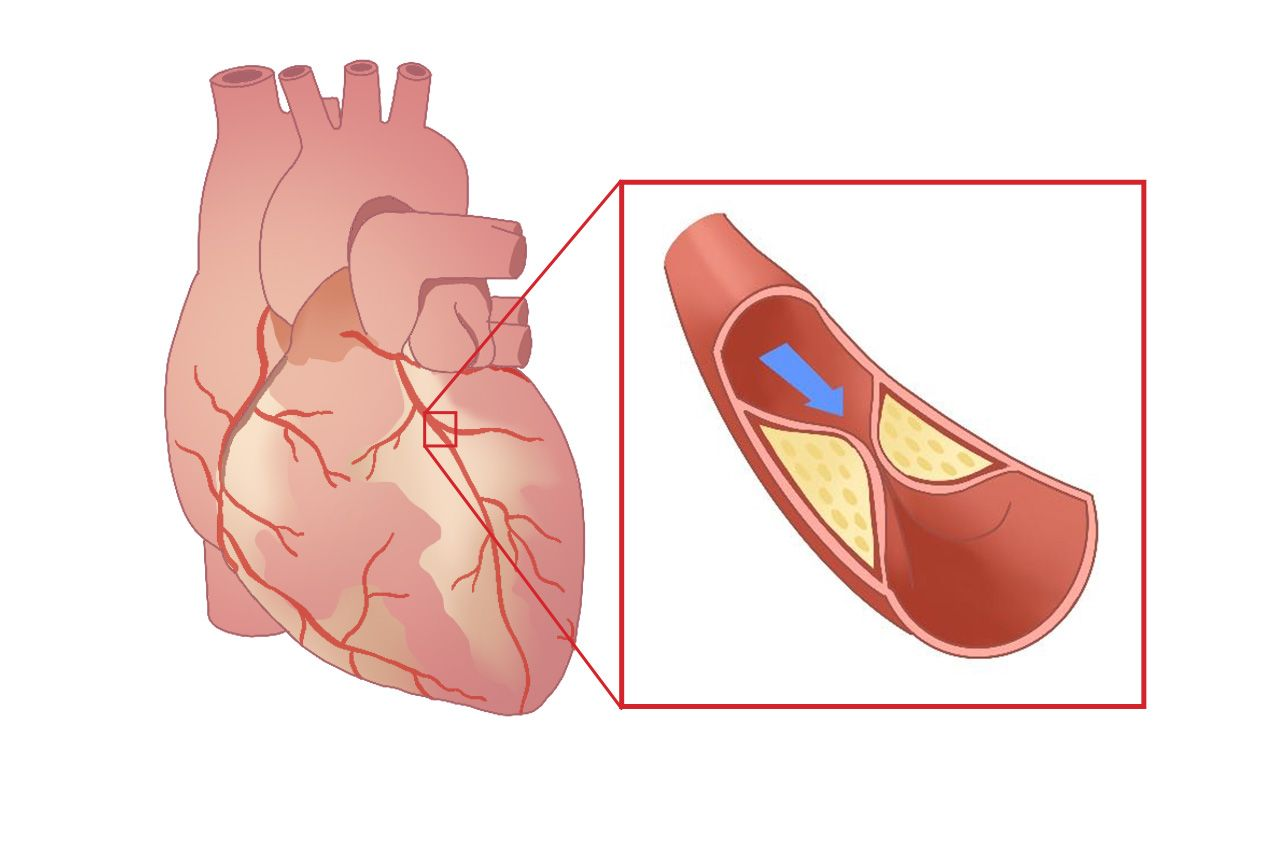 心血管狭窄图片（心血管狭窄的图片）