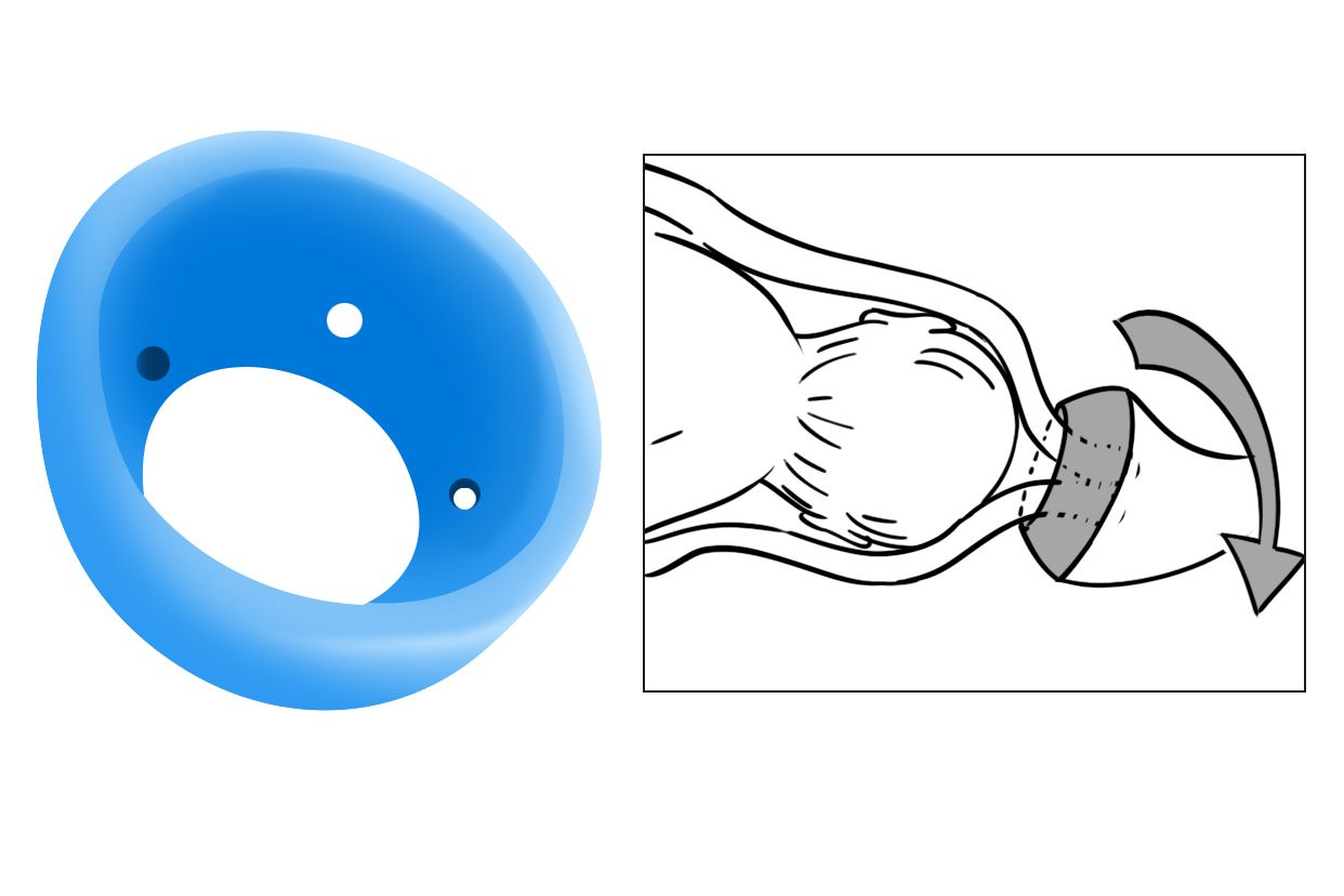 保胎用的宫颈托图片（孕妇宫颈短宫颈托图片）
