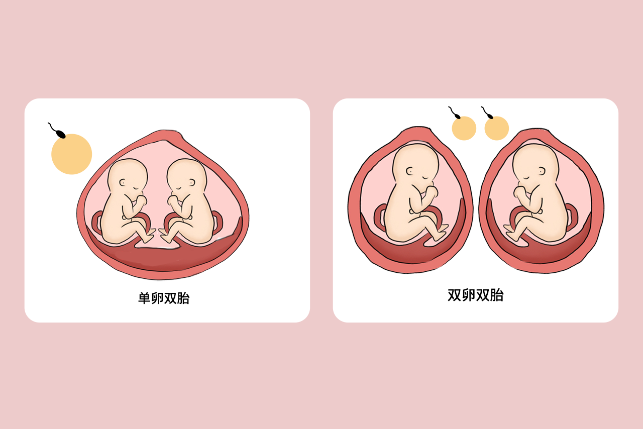 单卵双胎和双卵双胎区别图解 单卵双胎和双卵双胎区别图解图片