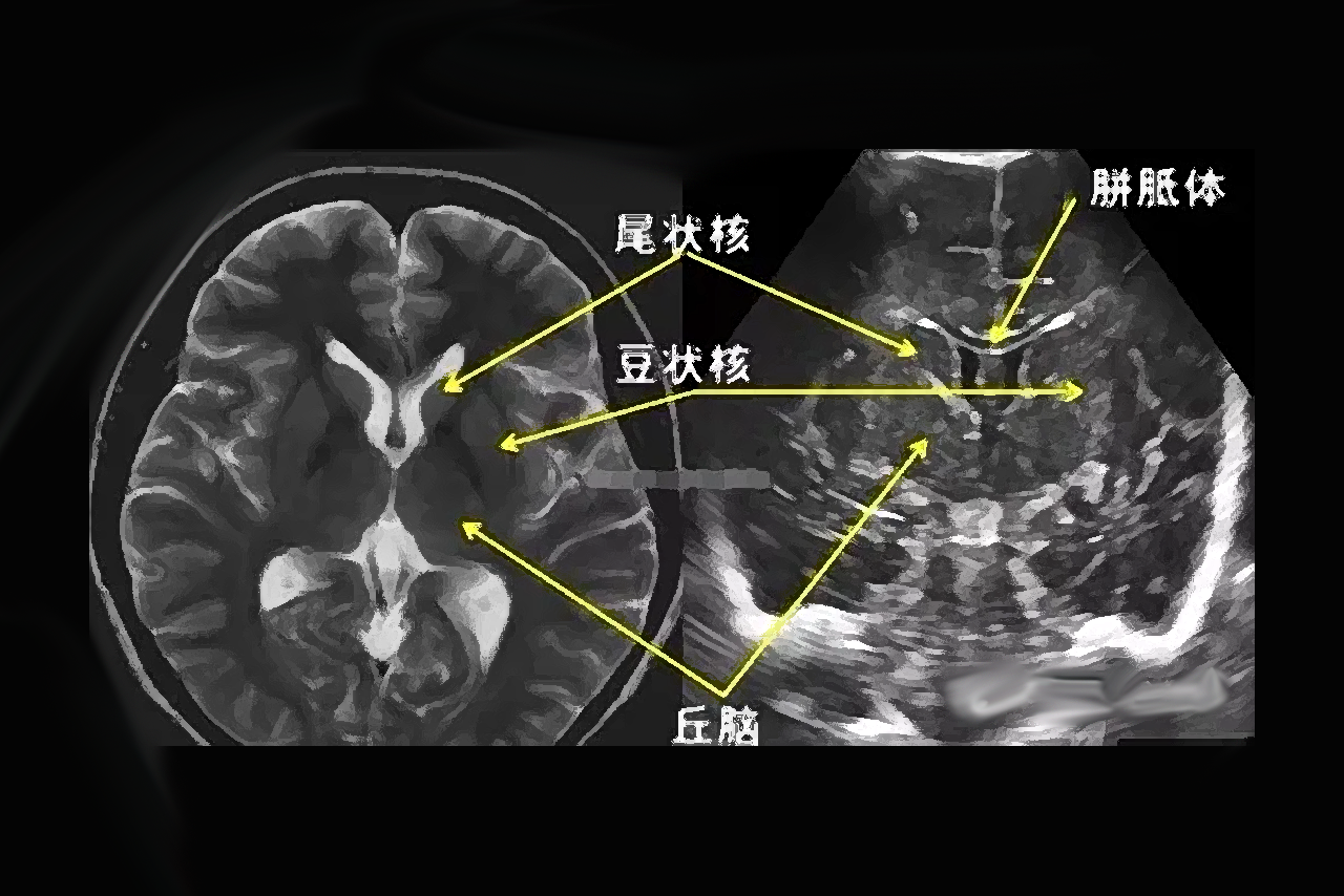 胎儿头颅结构图 胎儿颅内结构正常超声图谱