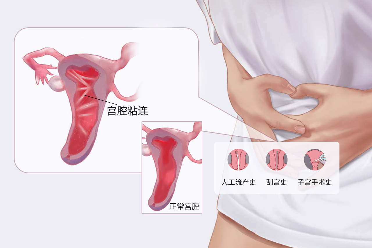 宫腔粘连和正常区别图