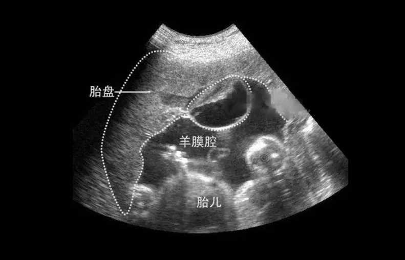 孕12周胎盘图