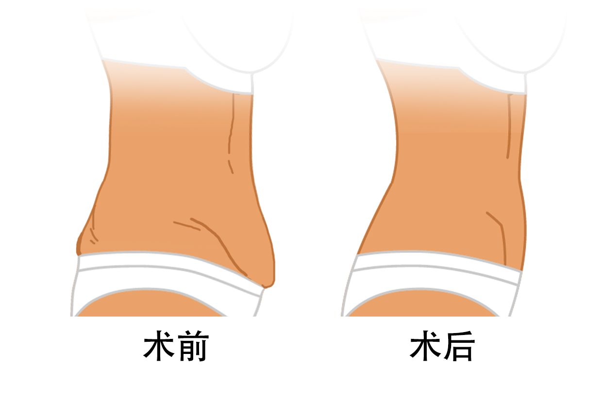 腹壁整形术前后效果图