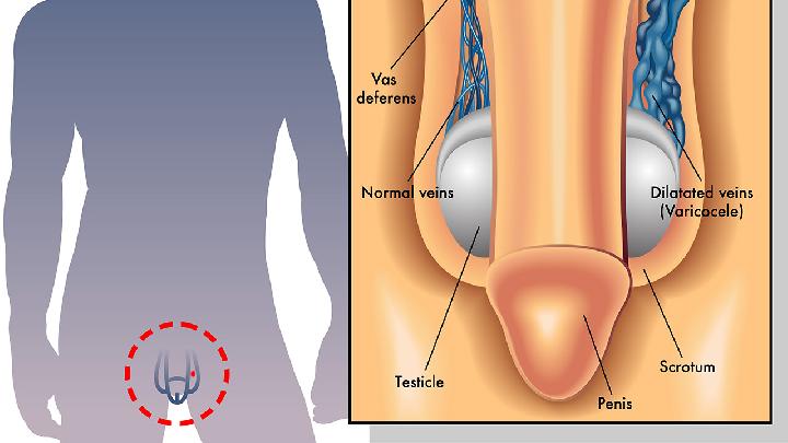 男性阴囊潮湿是肾阴虚吗 简述男性阴囊潮湿的治疗及预防