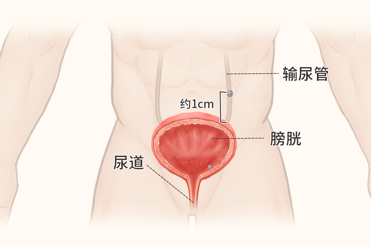 输尿管结石到膀胱1cm距离,1cm距离是什么样子图