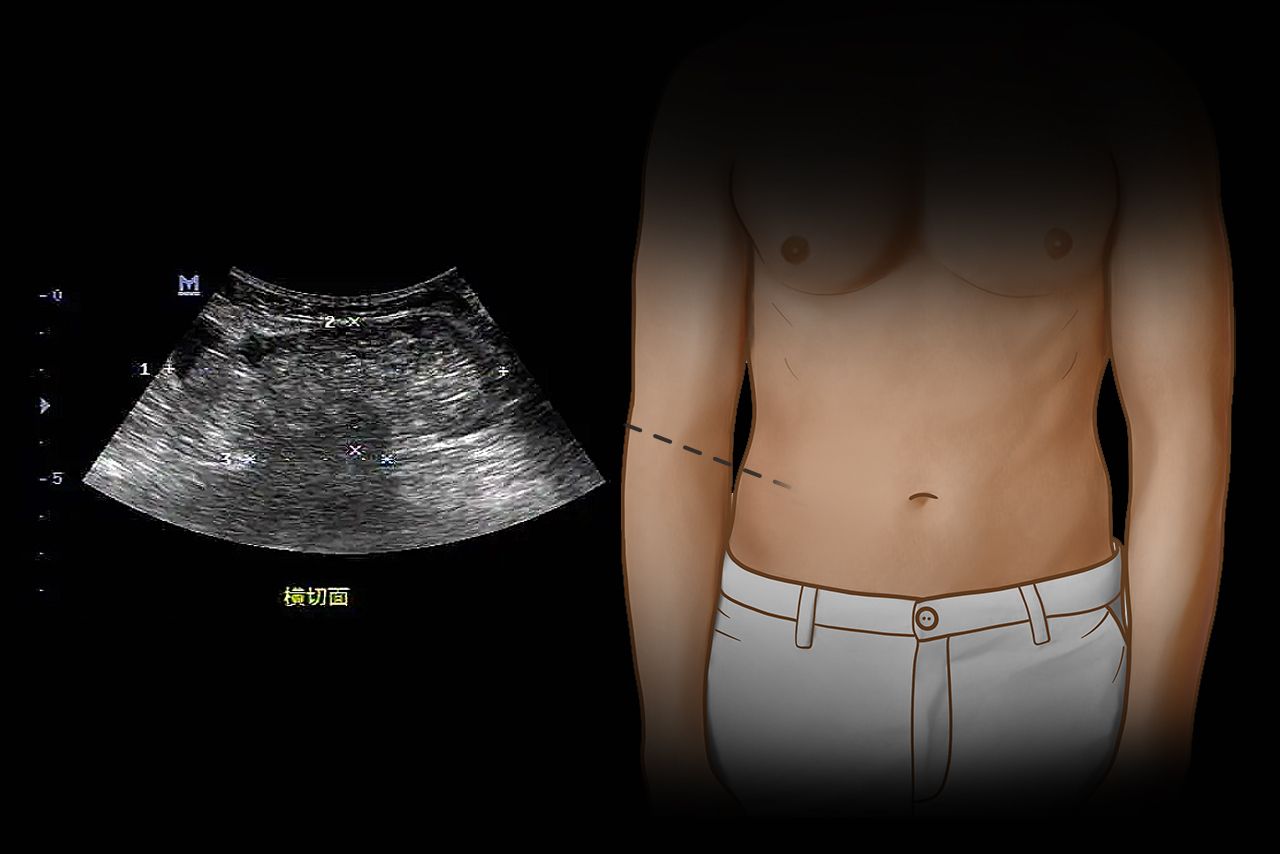 腹壁疝彩超报告图片（腹壁疝超声图片）