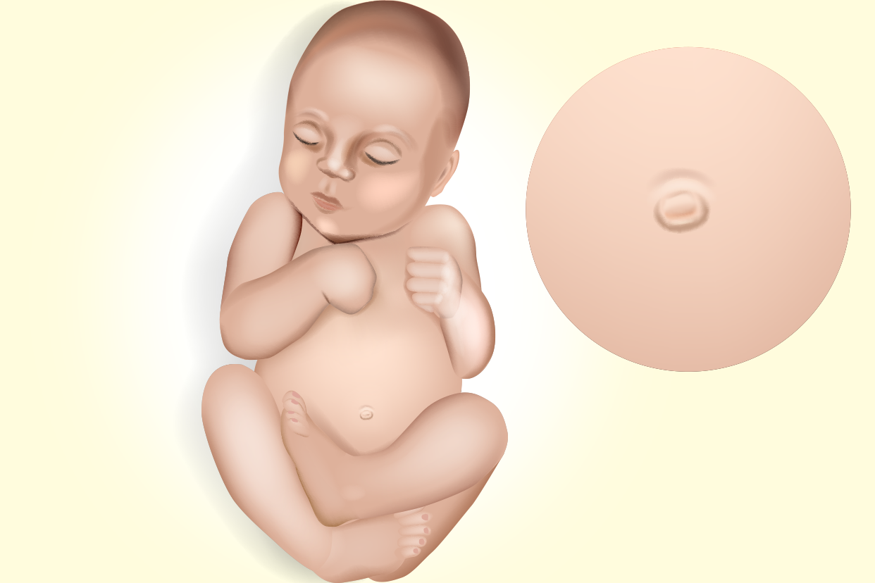 轻度脐疝初期图片 婴儿轻度脐疝初期图片