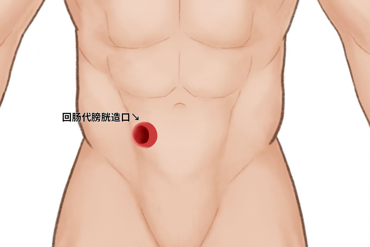 回肠代膀胱造口图片（回肠代膀胱术图片）