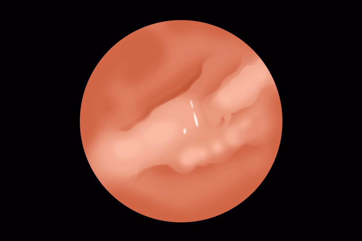 胃窦溃疡图片 胃窦溃疡图片位置示意图