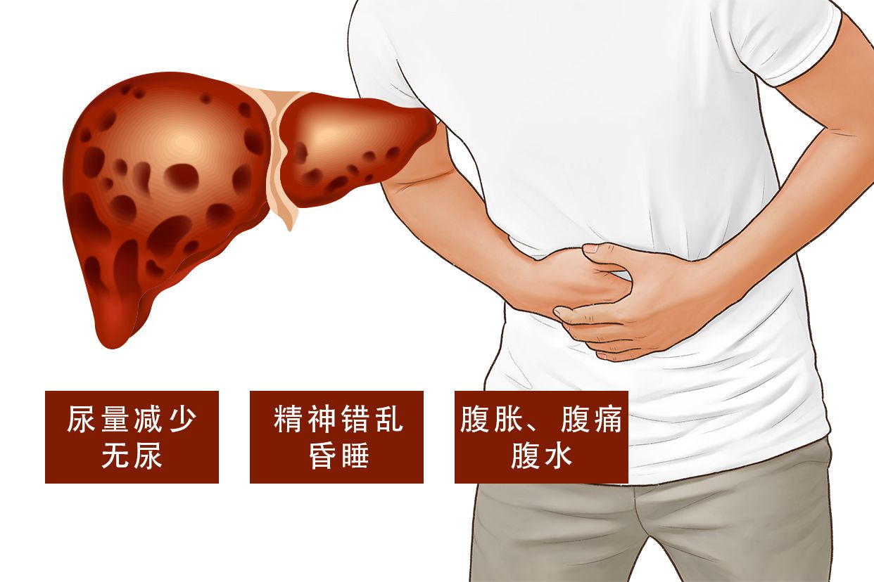 肝衰竭图片（肝功能衰竭图片）