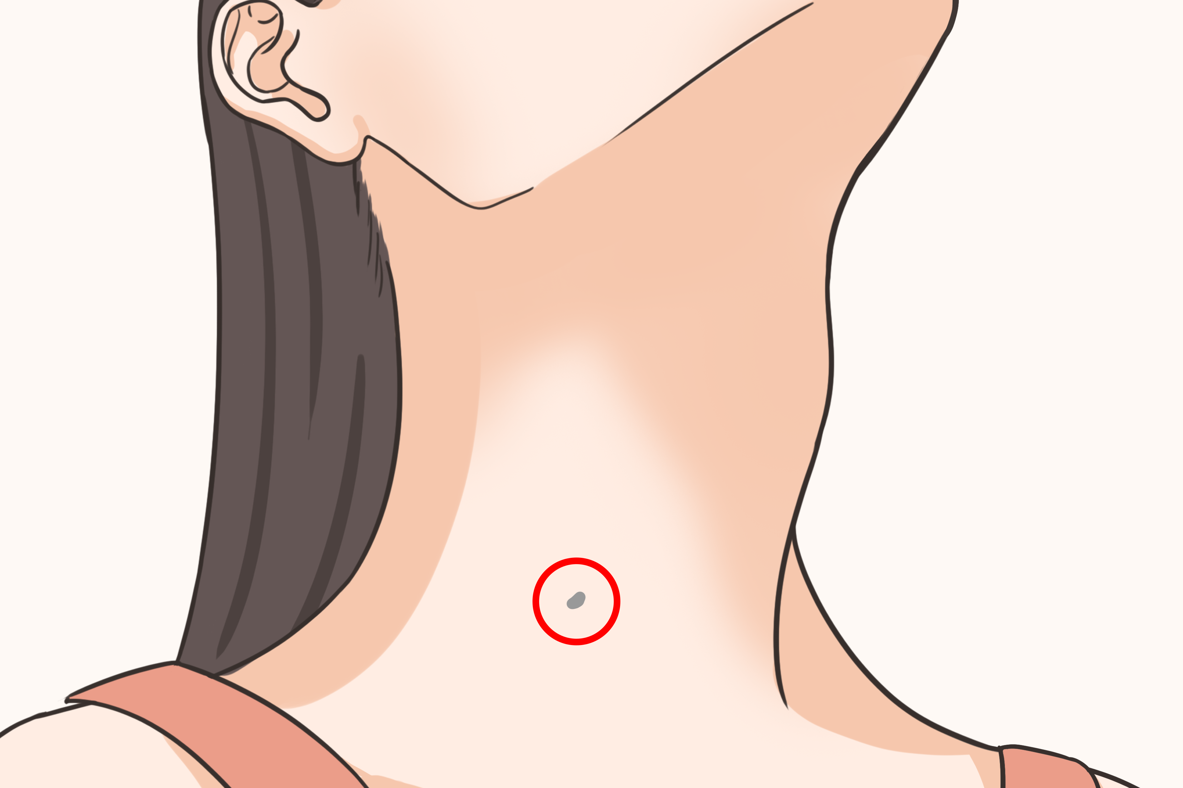 第一鳃裂瘘管外瘘口位置图 第一鳃裂瘘的位置是在哪里