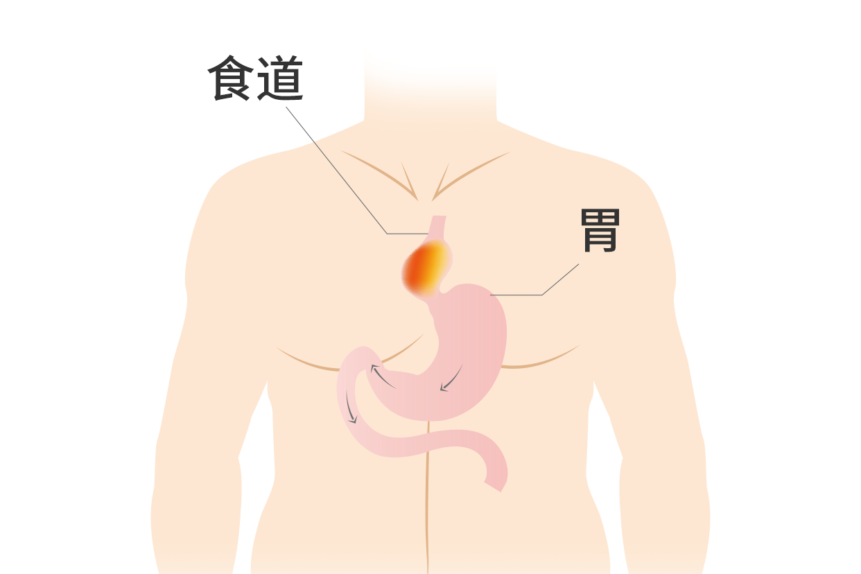 食管裂孔疝疼痛部位图（食管裂孔疝的位置）