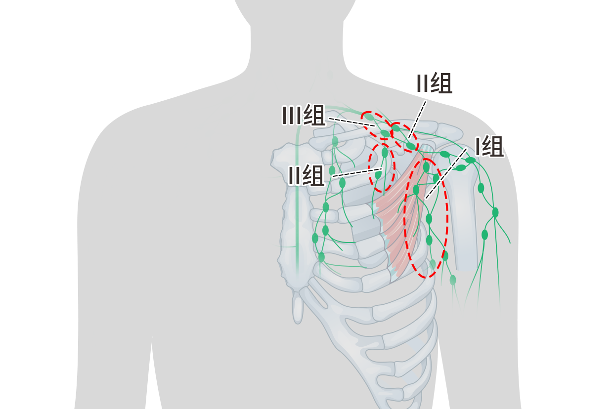 腋窝淋巴结分区第一水平图片 腋窝三水平淋巴结位置图