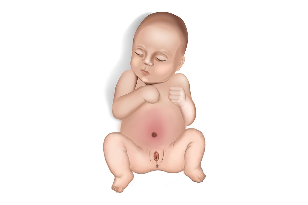 女宝宝小腹三角区鼓鼓的囊肿图片（女婴下腹部三角区肿）