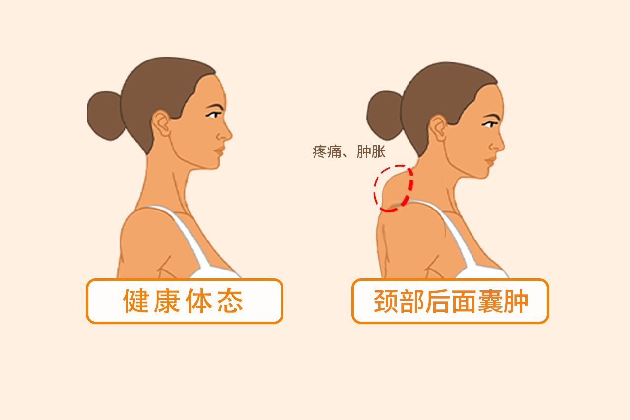 颈部后面囊肿症状图片女性 颈部后面囊肿症状图片