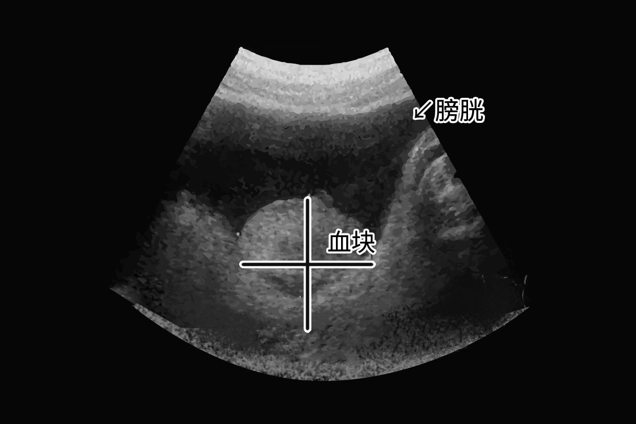膀胱内血块超声图片 膀胱血凝块的超声图片
