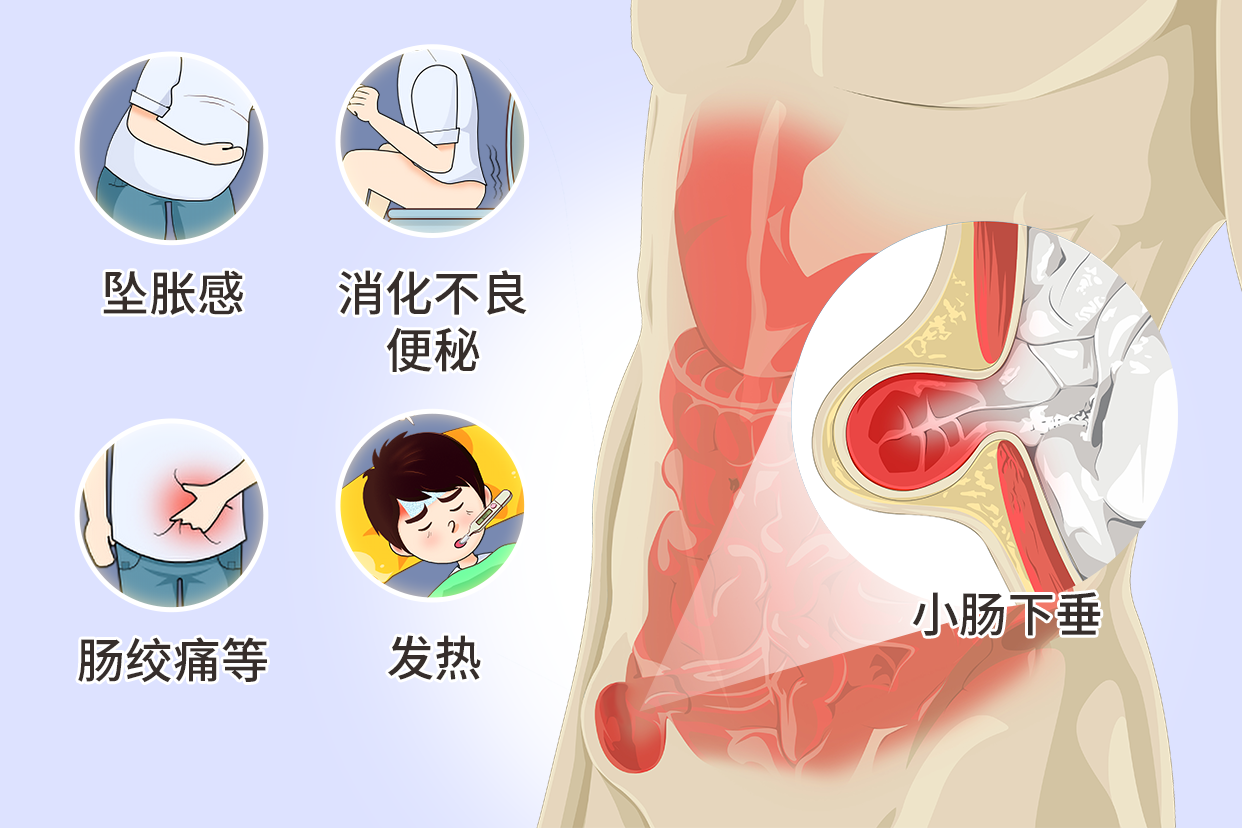 什么是小肠下垂图片 什么叫小肠下垂?